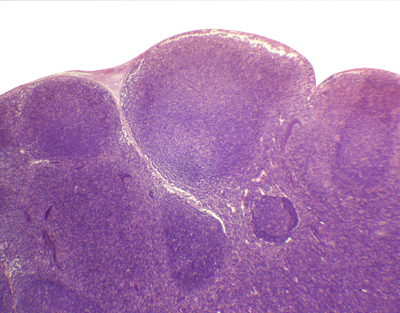 Lymph node, sec.