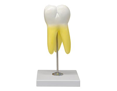 Upper molar, 3 roots